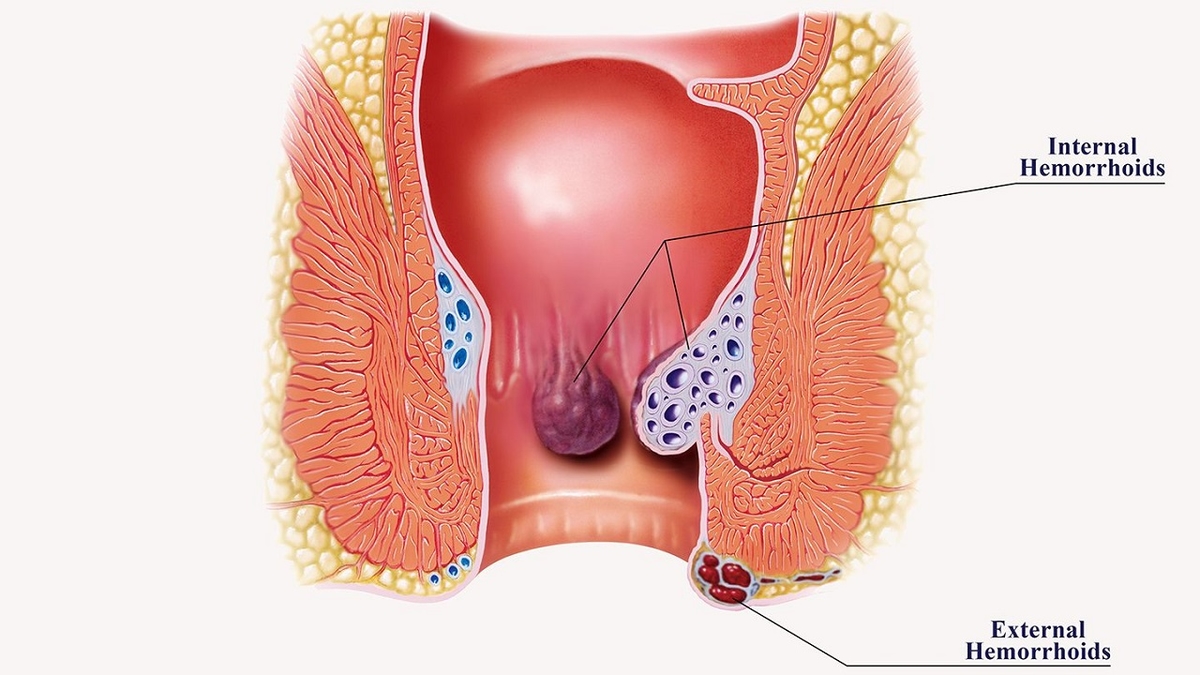 Bệnh trĩ nội độ 1 là gì &#8211; giải pháp điều trị hiệu quả