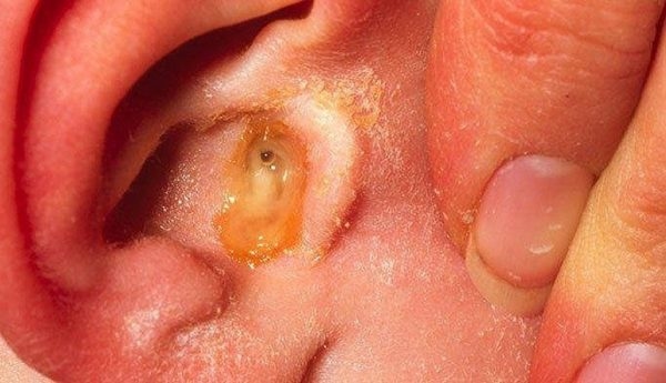 Bệnh viêm tai giữa ở trẻ sơ sinh là tình trạng tổn thương và viêm nhiễm xuất hiện ở trong tai giữa do virus, vi khuẩn hoặc các yếu tố bên ngoài môi trường gây ra