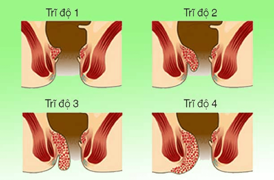 Cách điều trị trĩ nội hiệu quả &#8211; Góc giải đáp