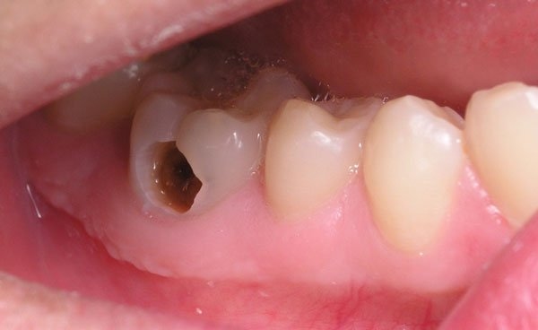 Chụp sứ răng hàm là phương pháp thẩm mỹ áp dụng được cho nhiều khuyết điểm của răng
