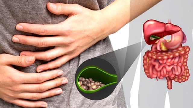Điều trị sỏi mật hiệu quả bằng cách nào?