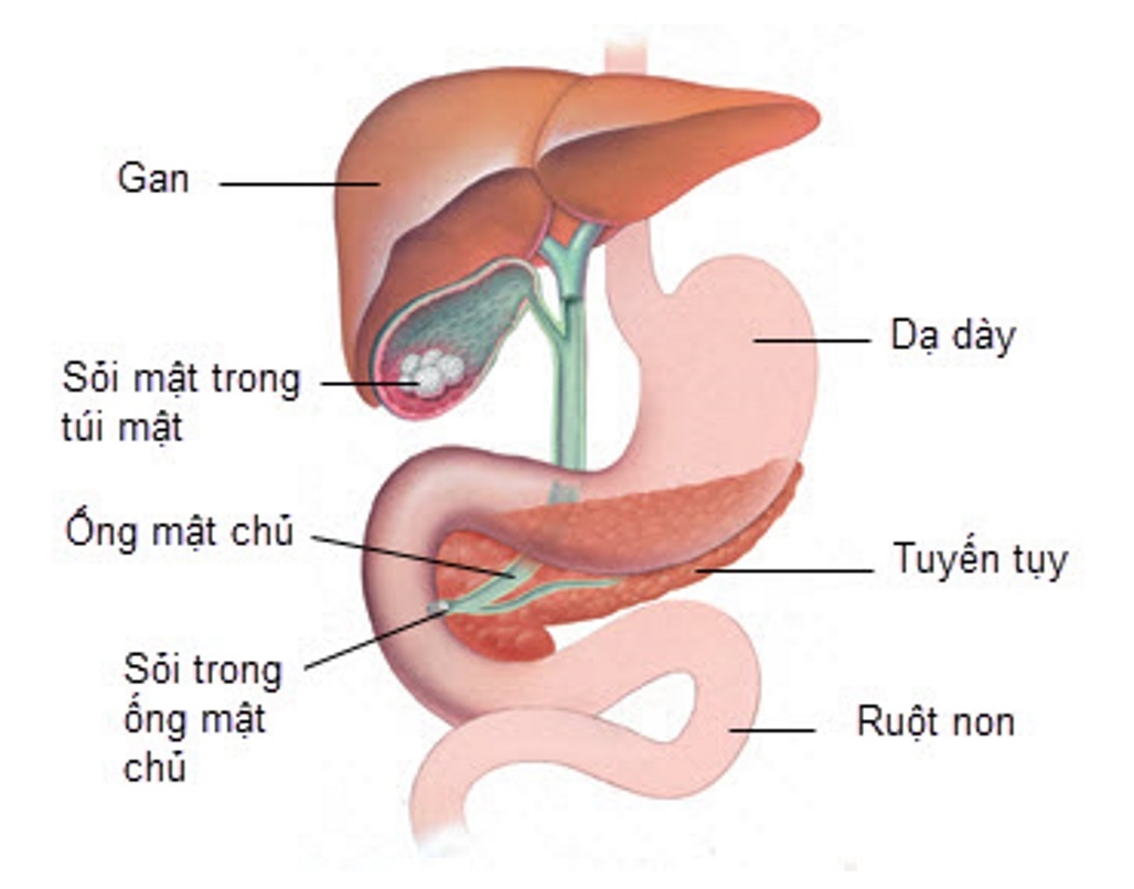Điều trị sỏi mật có thể dùng thuốc nhưng không thể dứt điểm