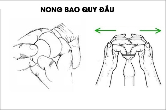 Nong bao quy đầu