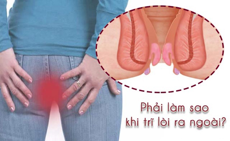 Phẫu thuật cắt bỏ búi trĩ được thực hiện khi trĩ ở giai đoạn nặng, búi trĩ sa không thể tự co lên