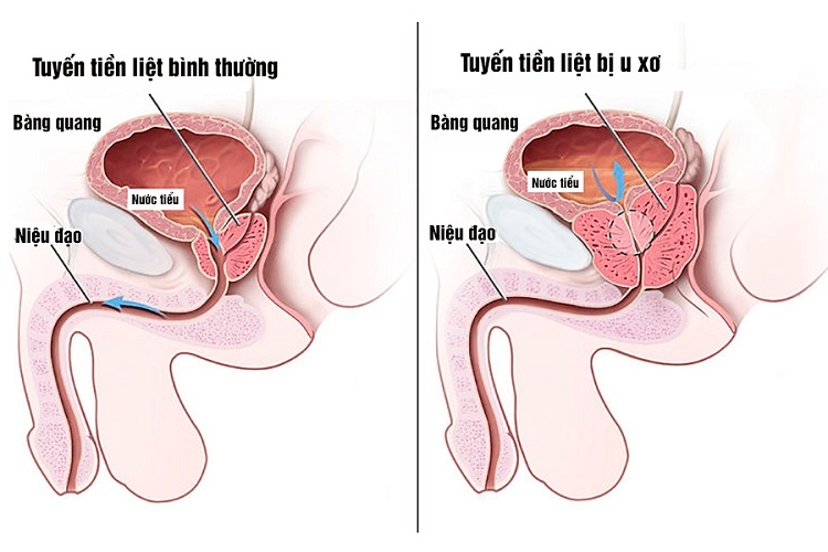 U xơ phì đại tuyến tiền liệt thường có biểu hiện bất thường ở đường tiểu