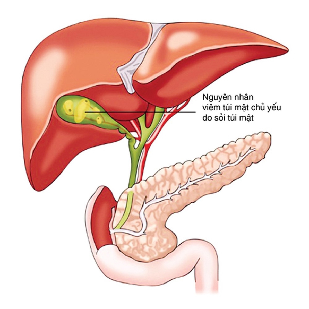 Viêm túi mật điều trị như thế nào?