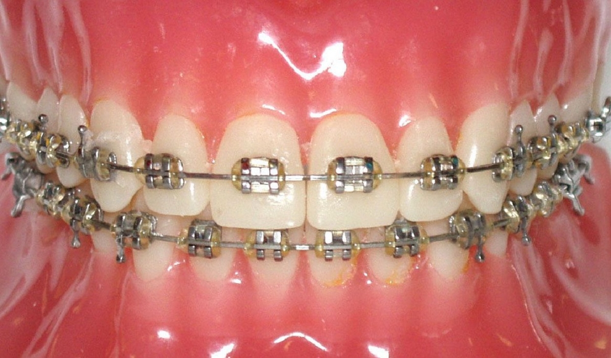 Giải đáp: Niềng răng hô có đau không