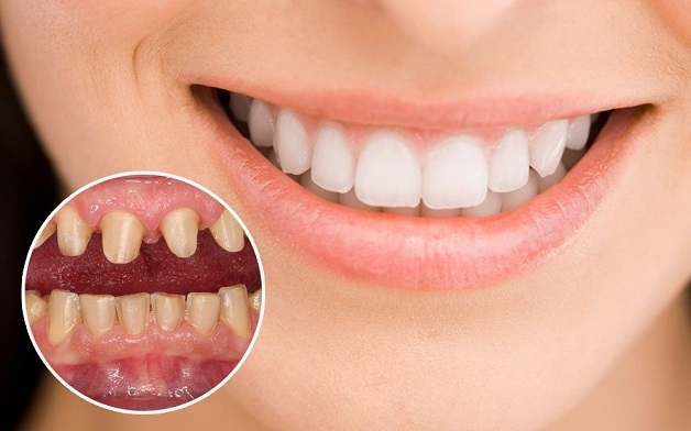 Bọc răng sứ cho răng thưa là giải pháp giúp khắc phục hiệu quả, khiến răng trở nên đều đẹp hơn và tránh được các bệnh lý răng miệng.