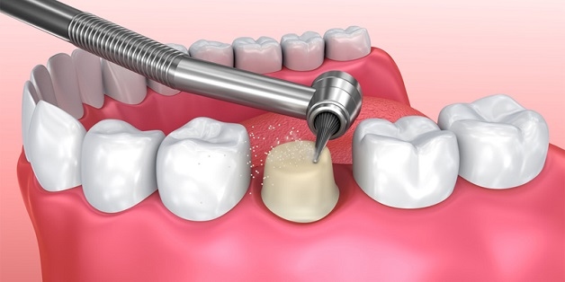 Để có thể gắn được mão răng lên, bác sĩ sẽ tiến hành mài cùi răng thật của bệnh nhân