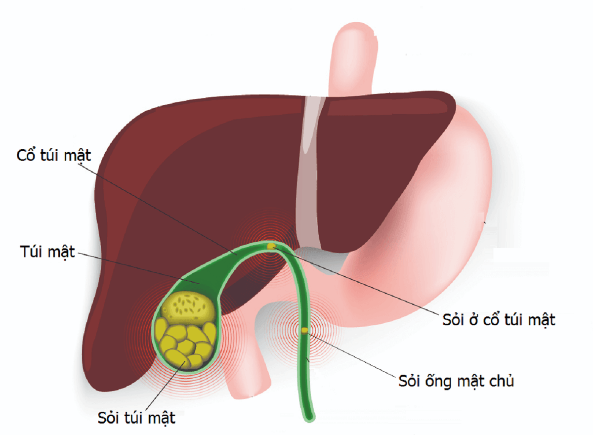 Giải đáp điều trị sỏi mật như thế nào?