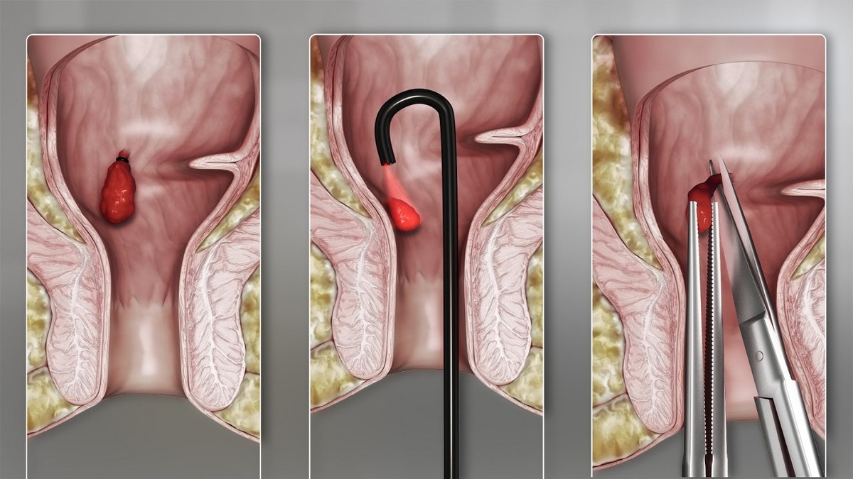 Nguyên nhân gây bệnh trĩ và cách điều trị trĩ hiện nay