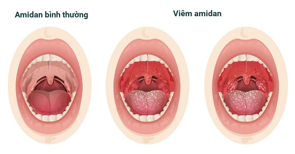 Viêm amidan là bệnh lý phổ biến có thể xảy ra với bất kỳ đối tượng nào