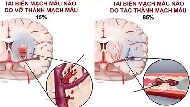 đột quỵ xuất huyết não ít gặp nhưng rất nguy hiểm