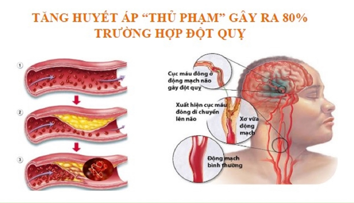 Top 6 nguyên nhân gây tai biến mạch máu não