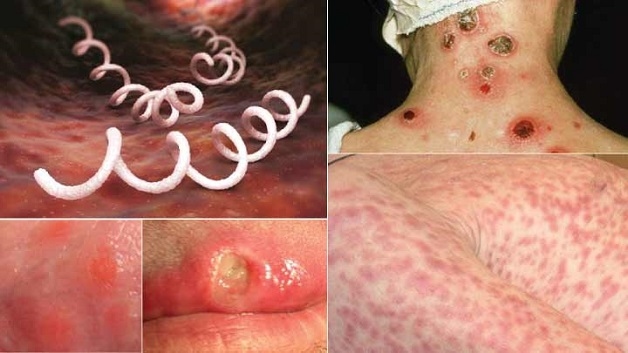nguyên nhân gây viêm dây thần kinh số 8
