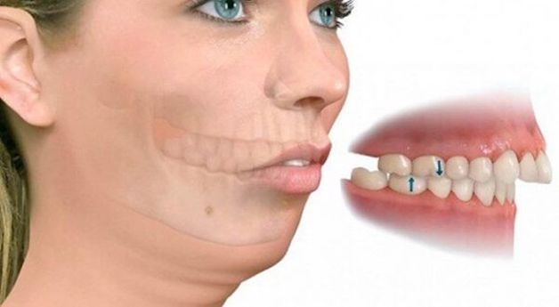 Ở những trường hợp hô nặng thì thường được chỉ định nhổ 4 răng số 4 để cải thiện tính thẩm mỹ