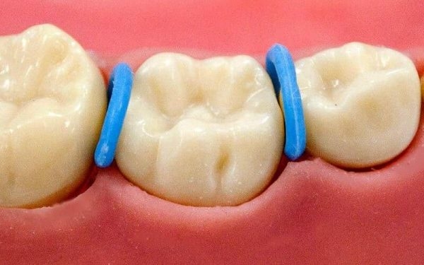 Với thắc mắc niềng răng hô có đau không, niềng răng có thể hơi đau nhức ở một số giai đoạn, ví dụ như đặt thun tách kẽ