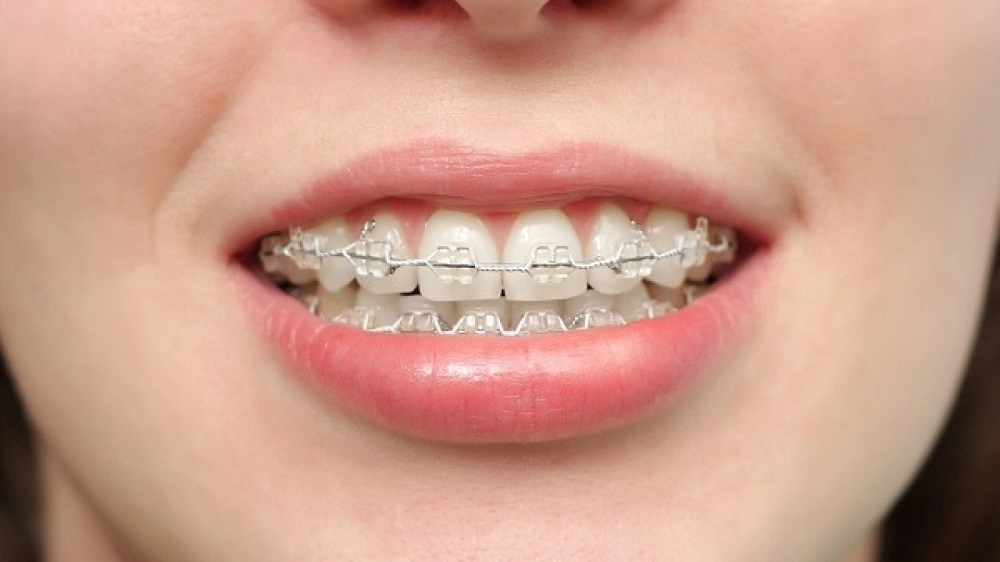 Giải đáp: Niềng răng hô có đau không
