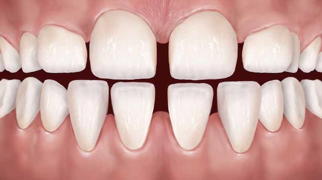 Răng thưa là một trong những trường hợp niềng răng không nhổ điển hình