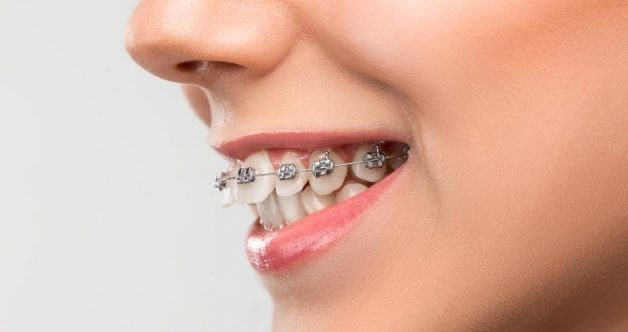 Niềng răng là gì