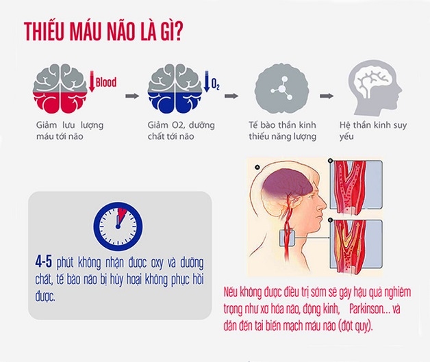 thiếu máu não có triệu chứng gì?