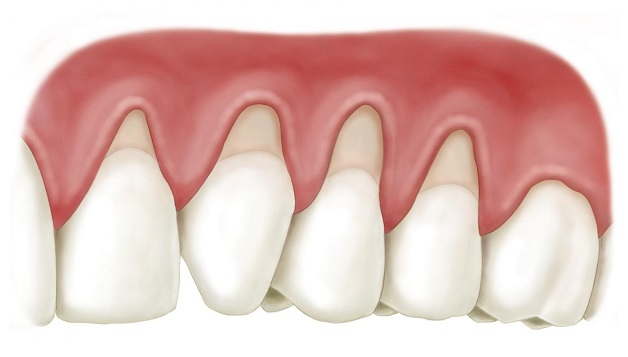 Tụt lợi là tình trạng chân răng bị lộ do nướu đang bị co lại, gây ra cảm giác ê buốt, mòn chân răng và tăng nguy cơ mắc các bệnh lý nguy hiểm khác.