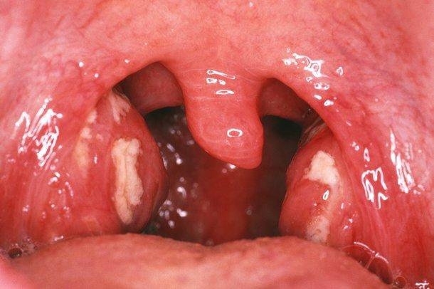 Cấu trúc của Amidan có nhiều ngóc ngách, khiến vi khuẩn sinh sôi và các hốc mủ bã đậu sẽ hình thành