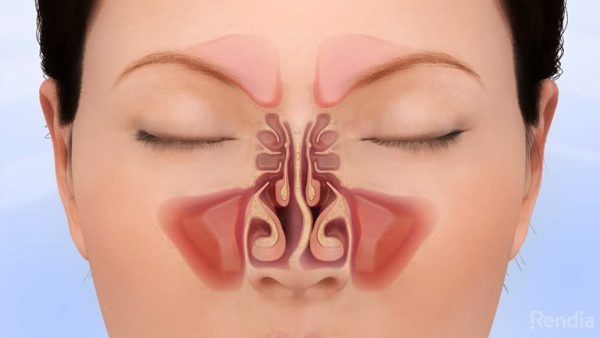 Người bệnh xuất hiện Polyp, thoái hóa cuốn mũi hay có cấu trúc giải phẫu như là lệch vắn ngăn, gai vách ngăn thì lúc này bắt buộc phải được can thiệp bằng phẫu thuật.