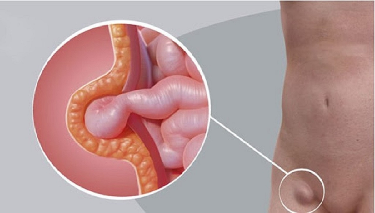 Điều trị thoát vị bẹn &#8211; thông tin cần biết