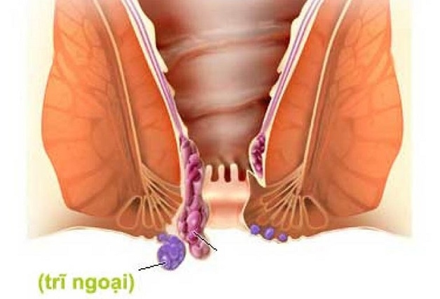 Điều trị trĩ ngoại độ 1 cần gì