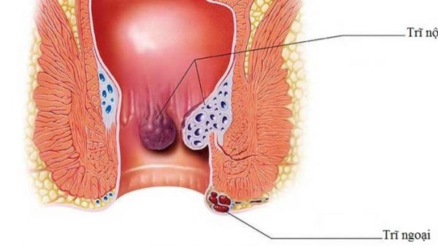 Điều trị trĩ ngoại độ 1 có cần hay không?