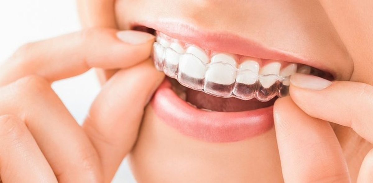 Giá niềng răng trong suốt hiện nay có cao không?