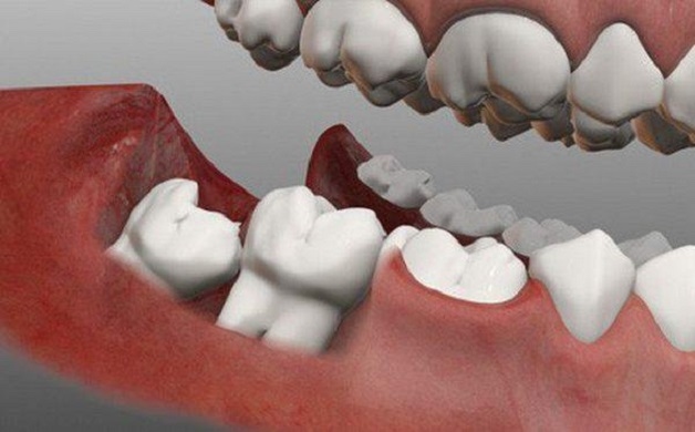 Răng cấm là răng số 6 và răng số 7 tính từ vị trí răng cửa