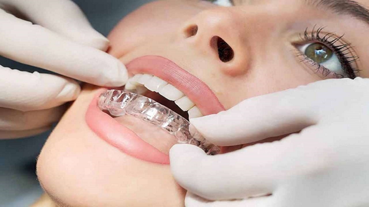 Niềng răng tháo lắp có hiệu quả hay không?
