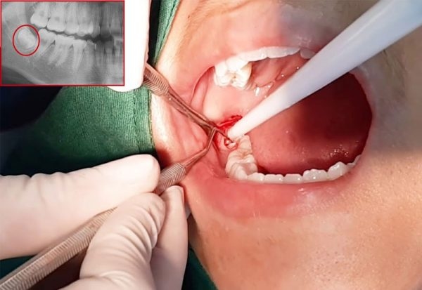 Răng số 8 bị sâu vỡ xuất phát từ nhiều nguyên nhân, chủ yếu là do người bệnh chủ quan không điều trị khi răng 8 có hiện tượng sâu