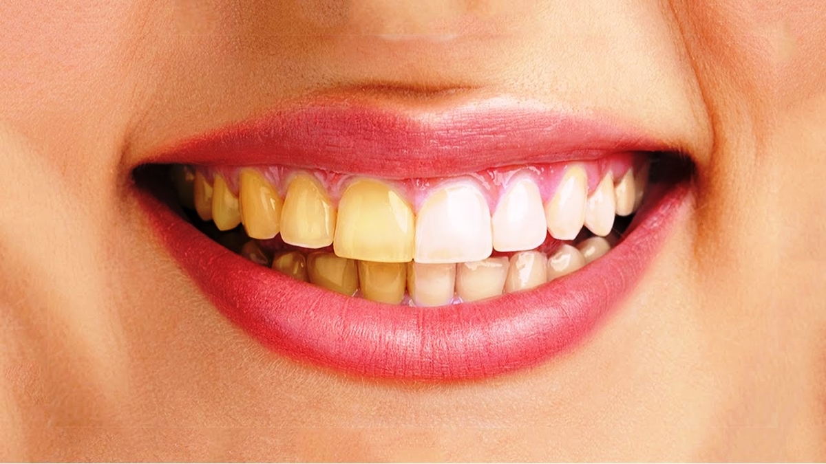 GIẢI ĐÁP: Răng vàng có tẩy trắng được không?