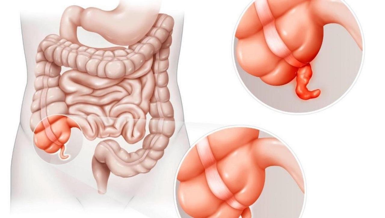 Bệnh viêm ruột thừa: Cách chẩn đoán và điều trị