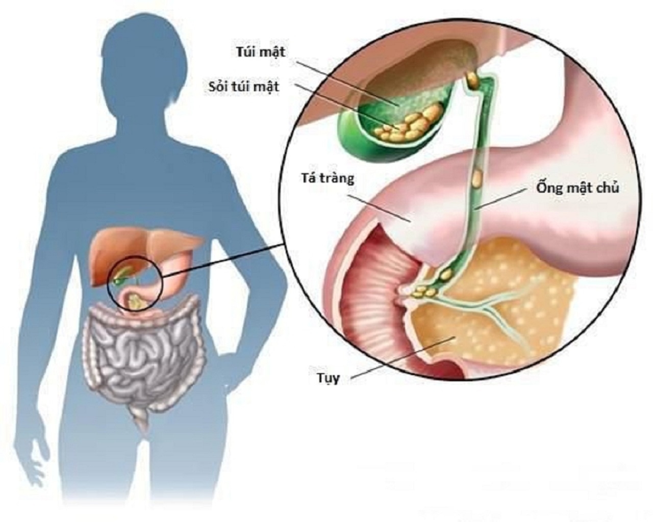 Cách điều trị bệnh sỏi mật &#8211; những  phương pháp phổ biến