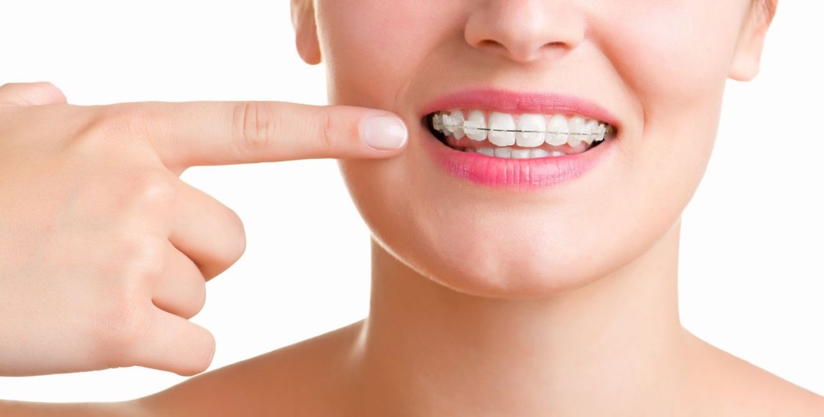 Giá niềng răng mắc cài sứ hiện nay thế nào? 
