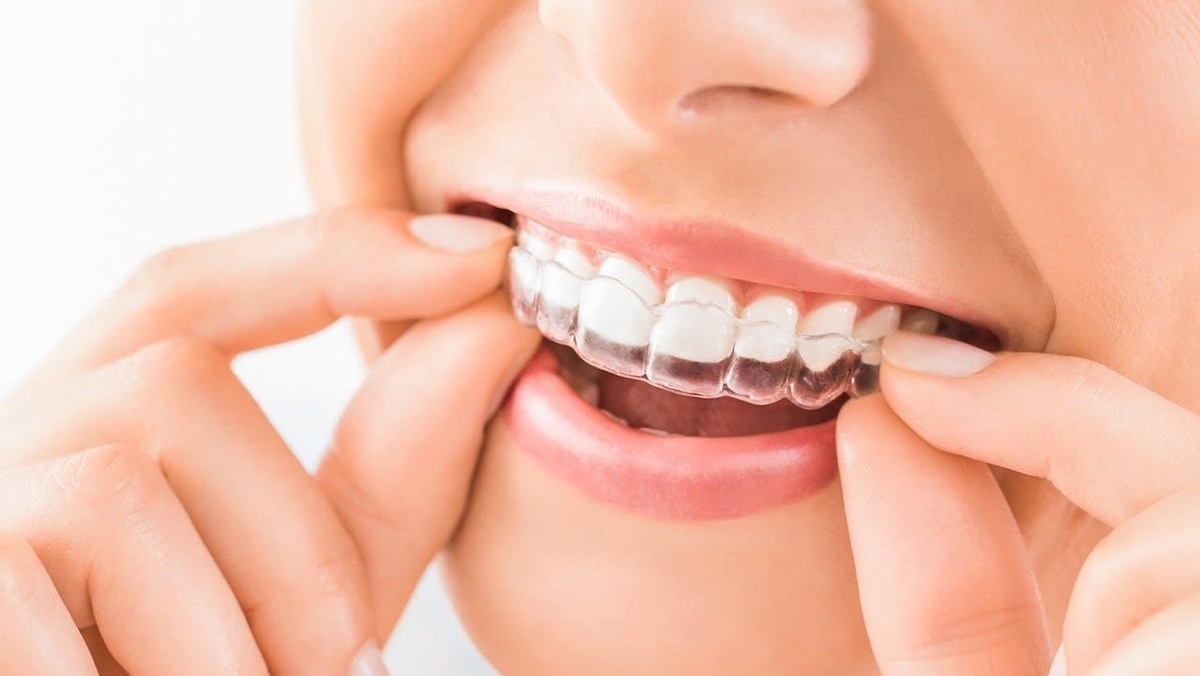 Giá niềng răng trong suốt hiện nay là bao nhiêu?
