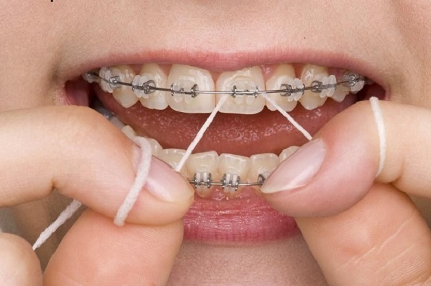 Niềng răng là phương pháp hiệu quả giúp cải thiện những khiếm khuyết ở răng, tăng tính thẩm mỹ cho hàm răng cũng như đảm bảo chức năng ăn nhai.