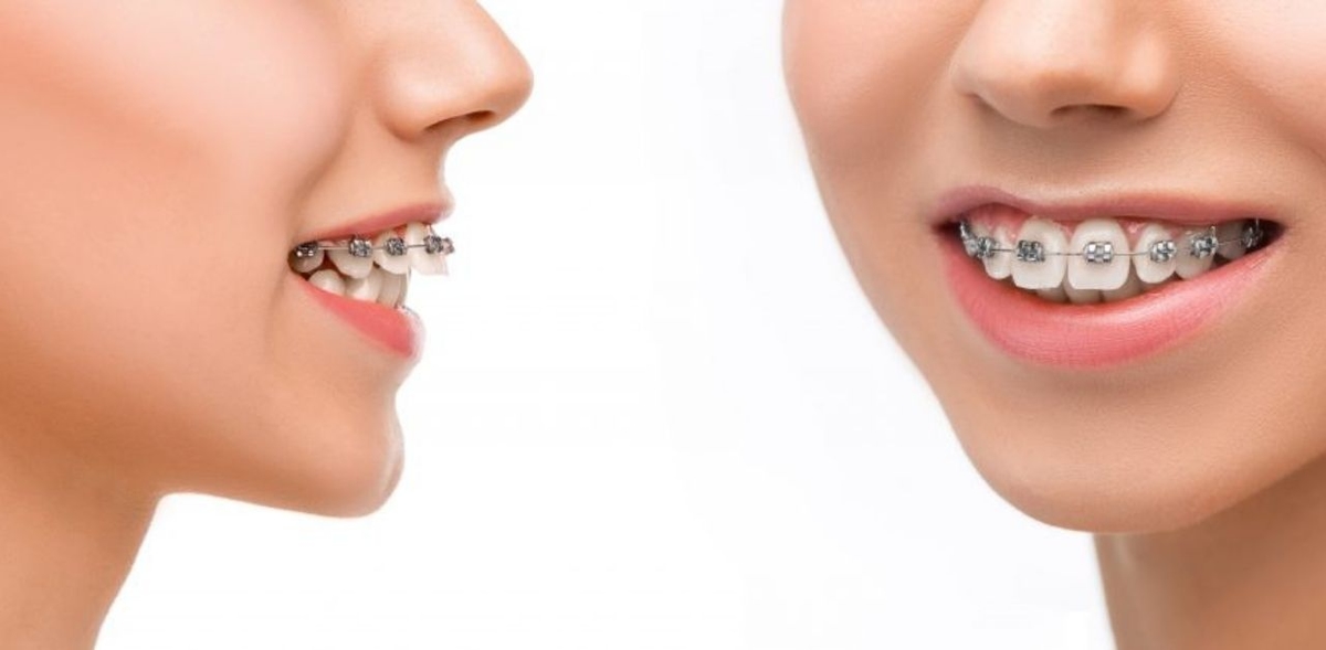 Niềng răng cố định &#8211; Chỉnh nha an toàn hiệu quả dài lâu