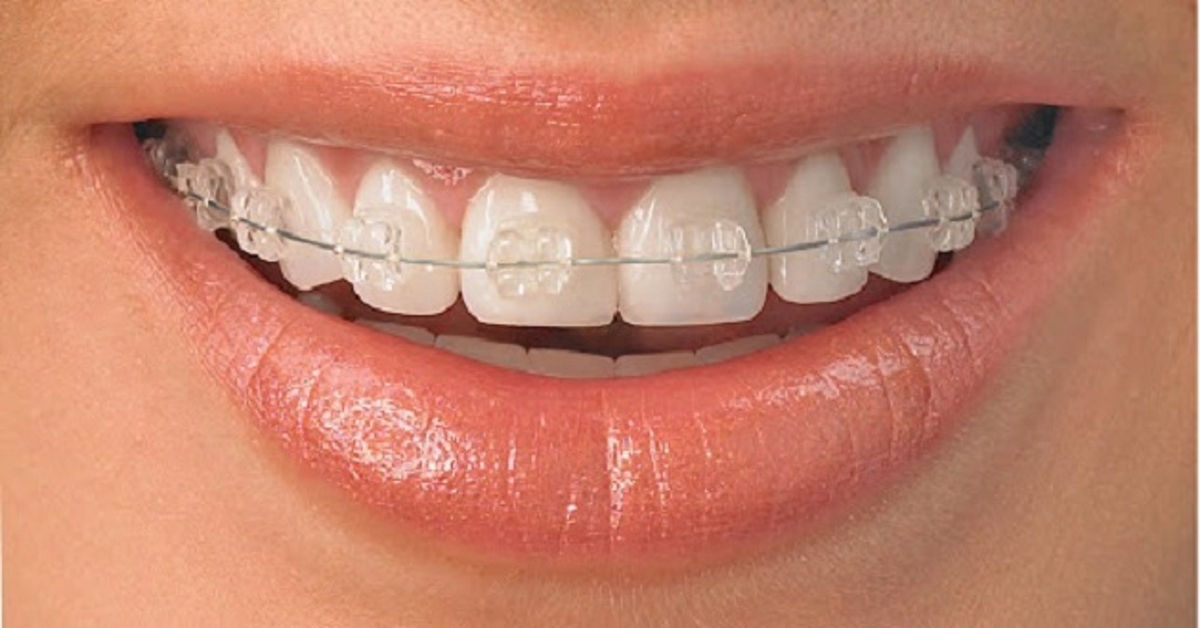 GIẢI ĐÁP: Niềng răng mắc cài sứ giá bao nhiêu? 