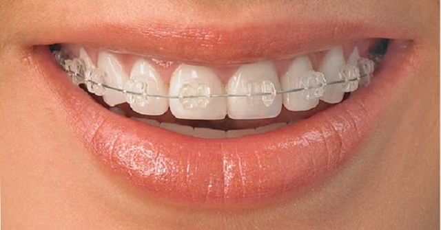 GIẢI ĐÁP: Niềng răng mắc cài sứ giá bao nhiêu? 