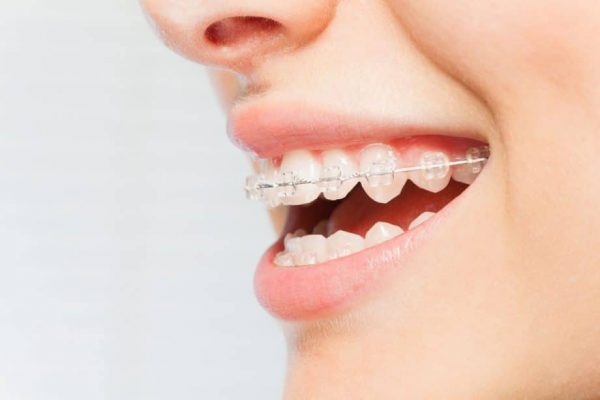 Niềng mắc cài trong suốt mang lại hiệu quả thẩm mỹ vượt trội và giúp người niềng tự tin hơn