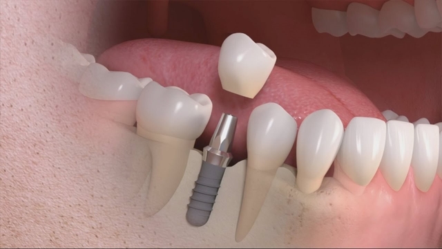 Tìm hiểu về quy trình trồng răng Implant 