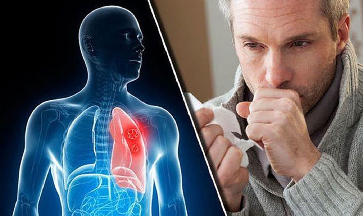 9 triệu chứng ung thư phổi không nên bỏ qua