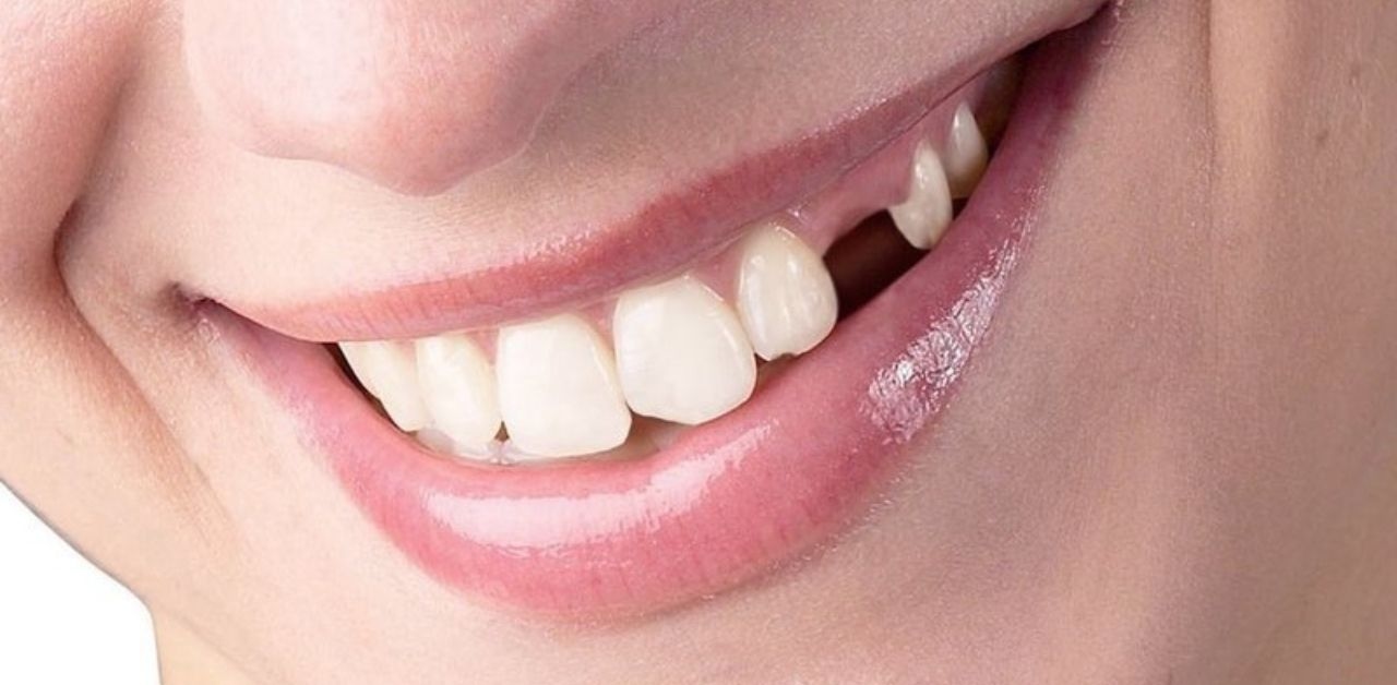 Có cần thiết phải trồng răng nanh không?