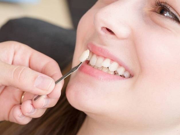 Ngày nay, trồng răng khểnh trở thành một xu hướng mới vô cùng được ưa chuộng