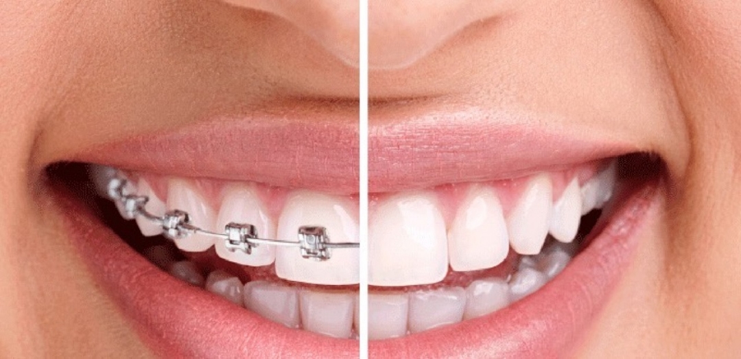 Trước và sau khi niềng răng gương mặt thay đổi thế nào? 